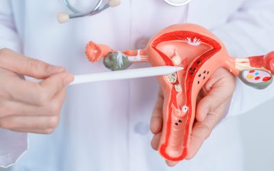 Tumores de ovario: Lo que toda mujer debe saber